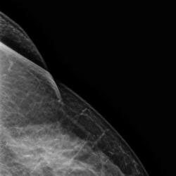 3D-Mammographie 