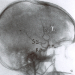 Cerebrale Angiografie mit Thorotrast, 1929