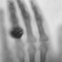 das erste Röntgenbild