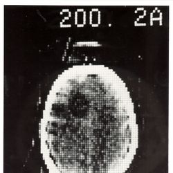 erstes klinisches CT-Bild, 1972