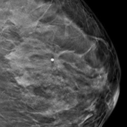2D-Mammographie der linken Brust