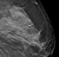 2D-Mammographie der linken Brust